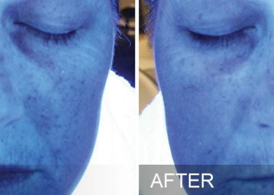 Before and after photo of a clients skin after receiving a hydration facial at Aesthetically Speaking in Reno, Nevada.